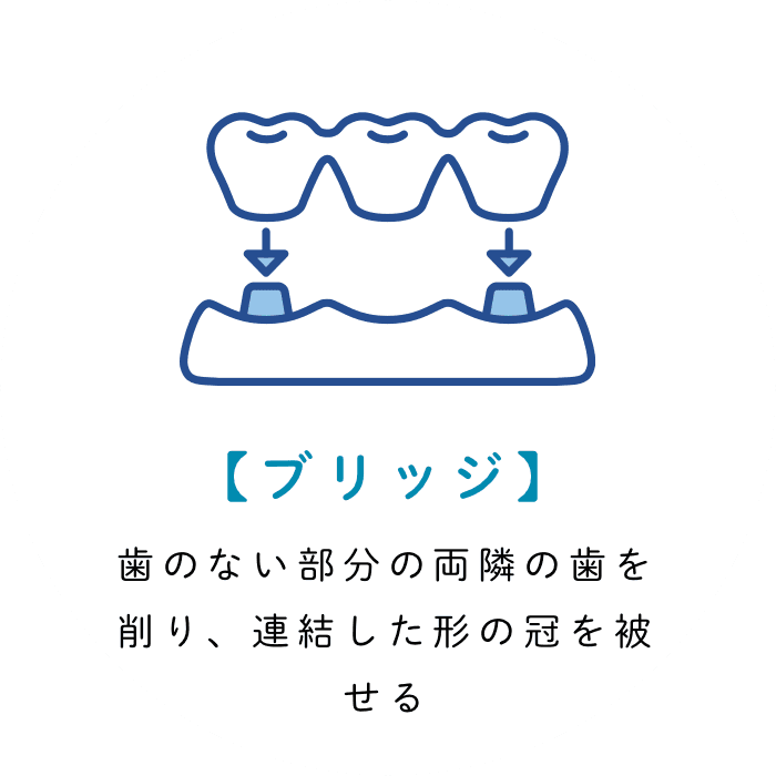 【ブリッジ】 歯のない部分の両隣の歯を削り、連結した形の冠を被せる